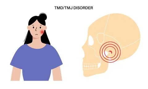 TMD TMJ disorder Stock Illustration