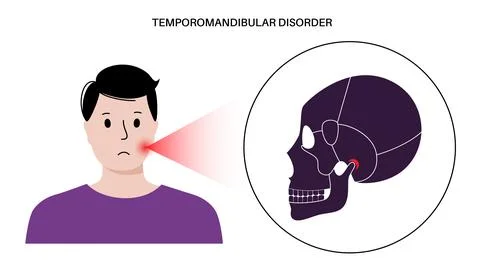 TMD TMJ disorder Stock Illustration