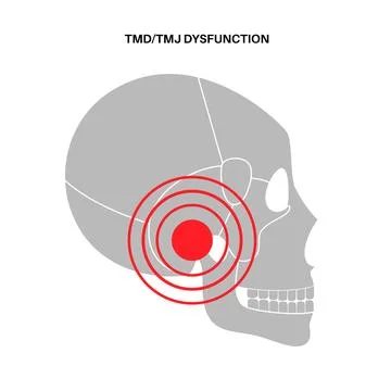 TMD TMJ disorder Illustrazione stock
