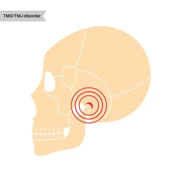TMD TMJ disorder Stock Illustration