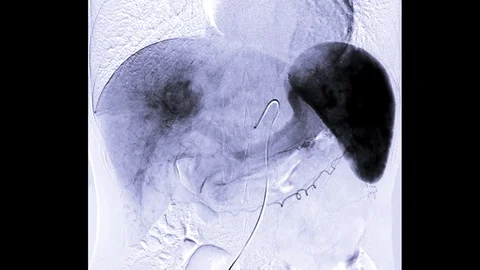 TOCE or Chemoembolization Stock Footage 116335137