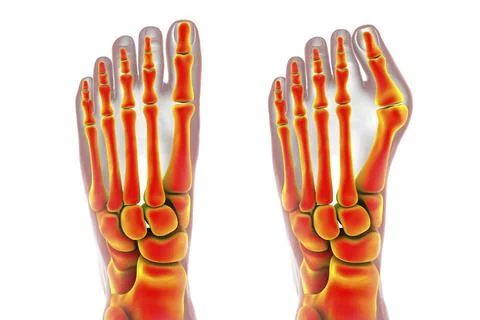 Toe deformation, also known as hallux valgus, or bunion Stock Illustration