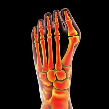 Toe deformation, also known as hallux valgus, or bunion Stock Illustration
