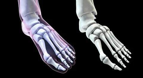 Toe deformation, also known as hallux valgus, or bunion Stock Illustration
