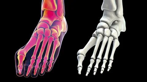 Toe deformation, also known as hallux valgus, or bunion Stock Illustration