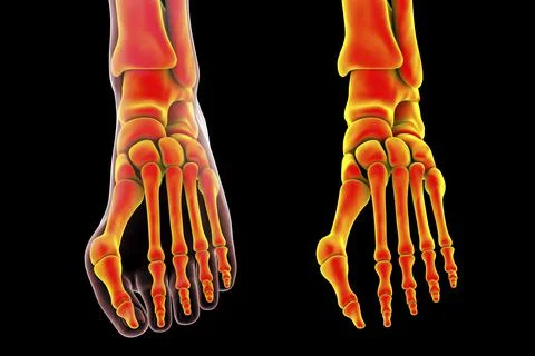Toe deformation, also known as hallux valgus, or bunion Stock Illustration