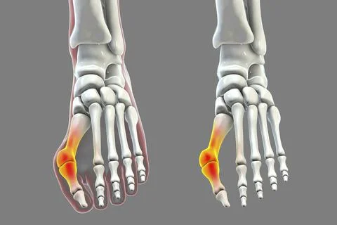 Toe deformation, also known as hallux valgus, or bunion Stock Illustration