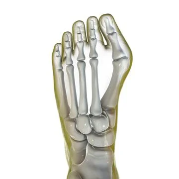 Toe deformation, also known as hallux valgus, or bunion Stock Illustration