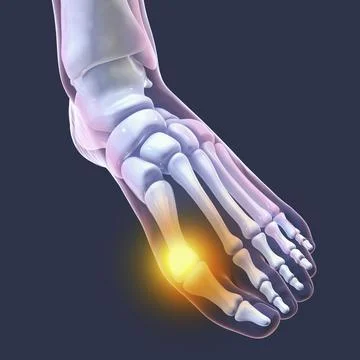 Toe deformation, also known as hallux valgus, or bunion Stock Illustration