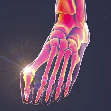Toe deformation, also known as hallux valgus, or bunion Stock Illustration
