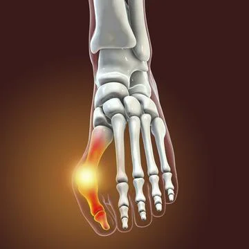 Toe deformation, also known as hallux valgus, or bunion Stock Illustration