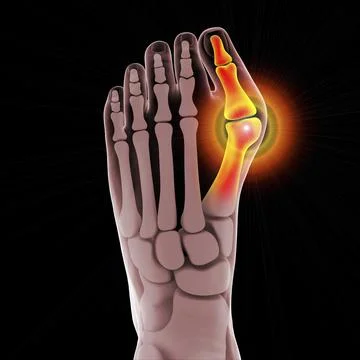 Toe deformation, also known as hallux valgus, or bunion Stock Illustration