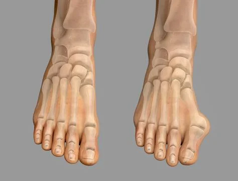 Toe deformation, also known as hallux valgus, or bunion Stock Illustration