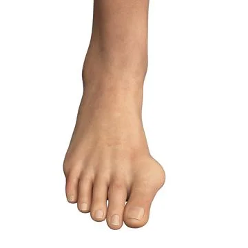 Toe deformation, also known as hallux valgus, or bunion Stock Illustration