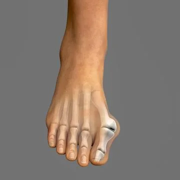 Toe deformation, also known as hallux valgus, or bunion Stock Illustration