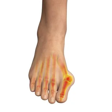 Toe deformation, also known as hallux valgus, or bunion Stock Illustration