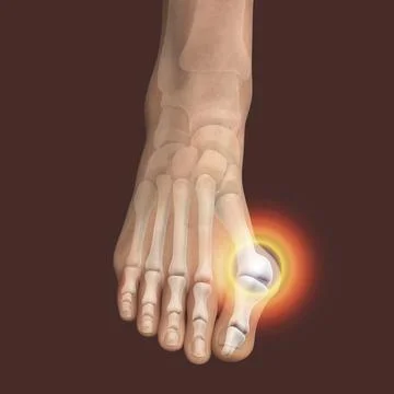 Toe deformation, also known as hallux valgus, or bunion Stock Illustration