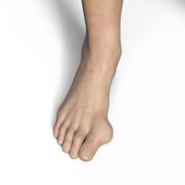 Toe deformation, also known as hallux valgus, or bunion, illustration Stock Illustration