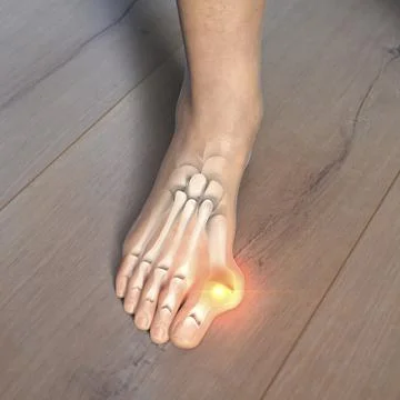 Toe deformation, also known as hallux valgus, or bunion, illustration Stock Illustration
