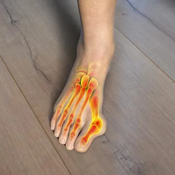 Toe deformation, also known as hallux valgus, or bunion, illustration Stock Illustration