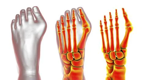 Toe deformation, also known as hallux valgus, or bunion Stock Illustration
