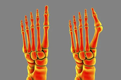 Toe deformation, also known as hallux valgus, or bunion Stock Illustration