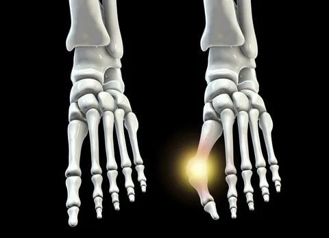 Toe deformation, also known as hallux valgus, or bunion Stock Illustration