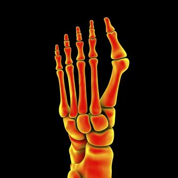 Toe deformation, also known as hallux valgus, or bunion Stock Illustration