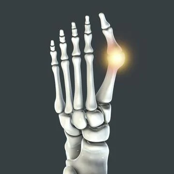 Toe deformation, also known as hallux valgus, or bunion Stock Illustration