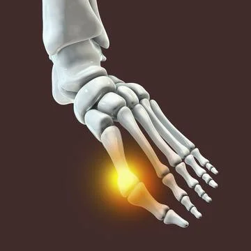 Toe deformation, also known as hallux valgus, or bunion Stock Illustration