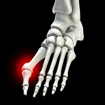 Toe deformation, also known as hallux valgus, or bunion Stock Illustration