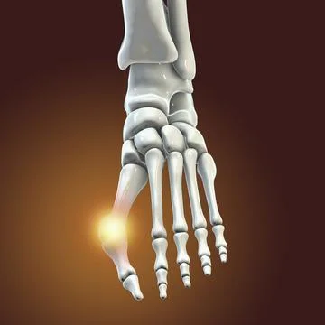 Toe deformation, also known as hallux valgus, or bunion Stock Illustration