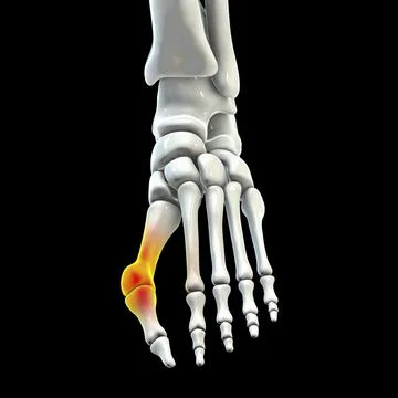 Toe deformation, also known as hallux valgus, or bunion Stock Illustration