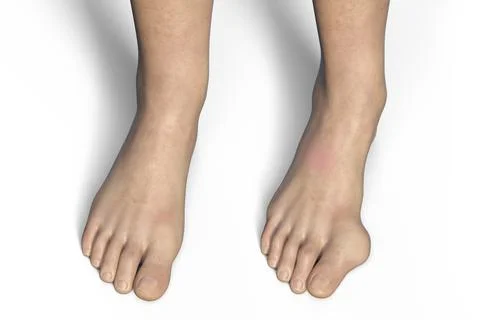 Toe deformation, also known as hallux valgus, or bunion, illustration Stock Illustration