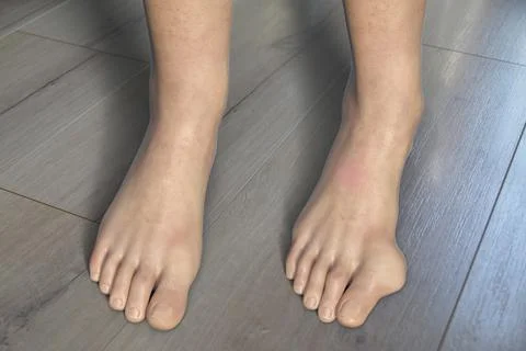 Toe deformation, also known as hallux valgus, or bunion, illustration Stock Illustration