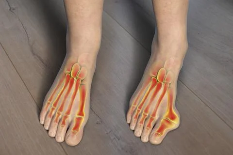 Toe deformation, also known as hallux valgus, or bunion, illustration Stock Illustration