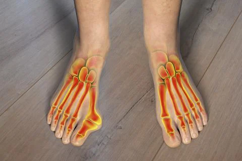 Toe deformation, also known as hallux valgus, or bunion Illustrazione stock