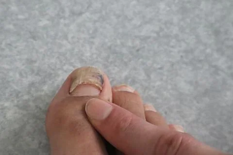 A toe with a nail that looks like it's about to come off. Stock Photos