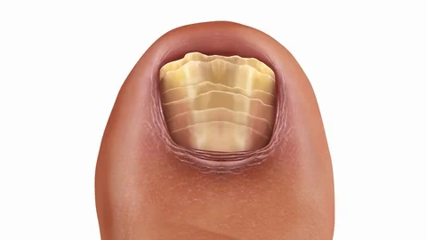 Toe-Nail-Treatment Stock Footage 115261581