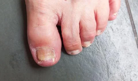 Toenails with Alterations Stock Photos