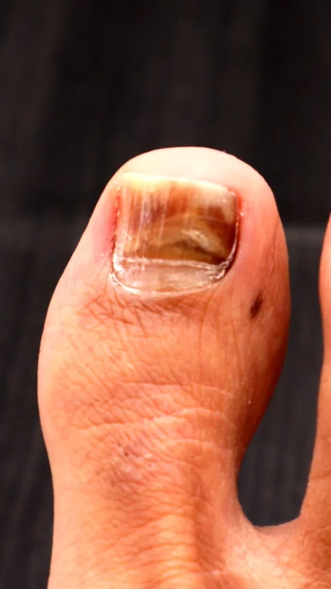 Toenails that have turned black due to injury Stock Footage 335241984