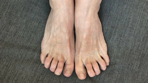 Toes problem nails. Top view Stock Footage 228947988