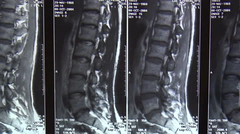 Tomography, Imaging of the spine. Picture. Video stock 45284777