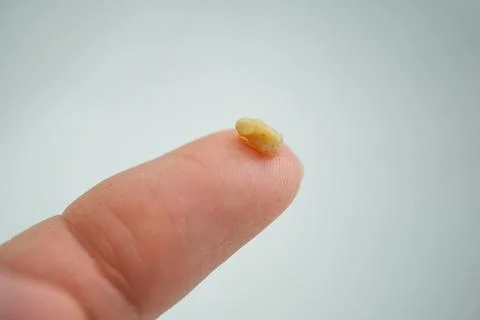 Tonsil stone close up on white background - tonsil stones on finger close up Foto stock