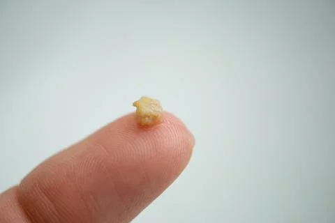 Tonsil stone close up on white background - tonsil stones on finger close up Foto stock