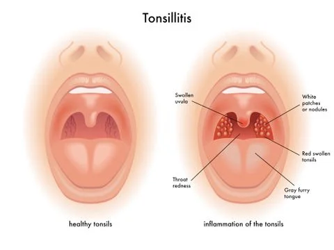 Tonsillitis Illustrazione stock