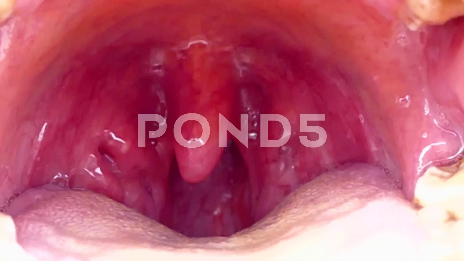 Tonsils Stock Footage ~ Royalty Free Stock Videos | Pond5