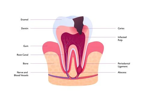 Tooth anatomy and decay chart. Cross section with text Stock Illustration