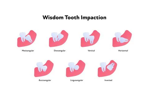 Tooth anatomy chart.  Cross section. Wisdom teeth impaction Stock Illustration