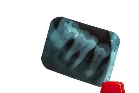 Tooth and overlapping teeth in X-ray film showing and tweezer on white backgr Stock Photos